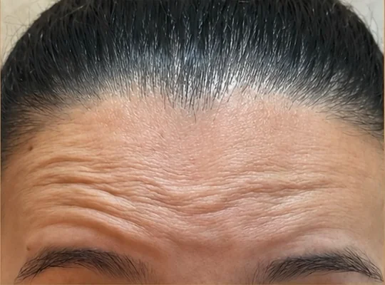 Testa com linhas de expressão, antes do Botox