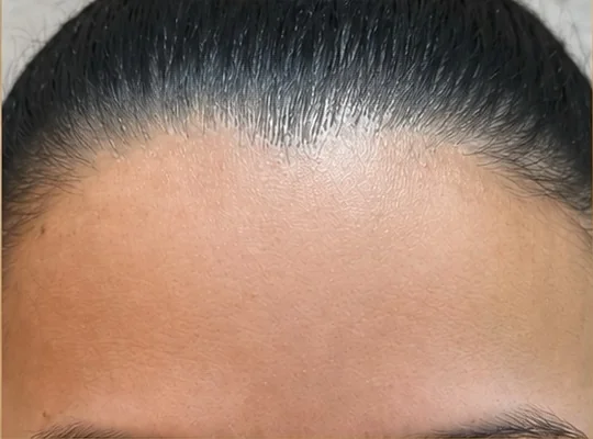 Testa suavizada, depois do Botox