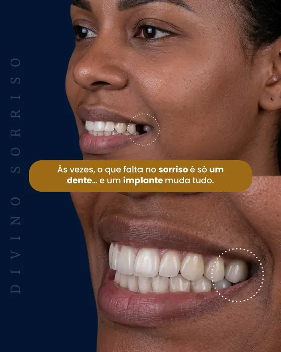 Implante dentário antes e depois
