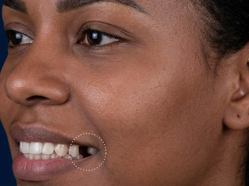 Sorriso com dente ausente, antes do implante