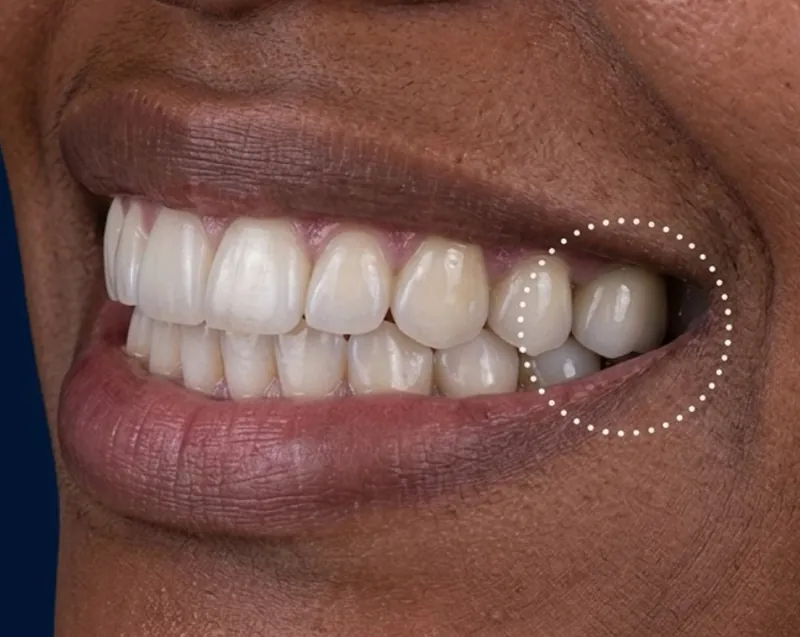 Sorriso completo depois do implante
