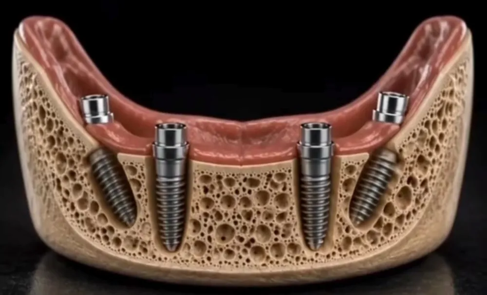 Modelo de implantes no osso