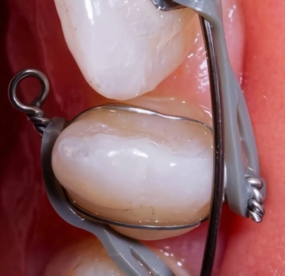 Aparelho ortodôntico em detalhe